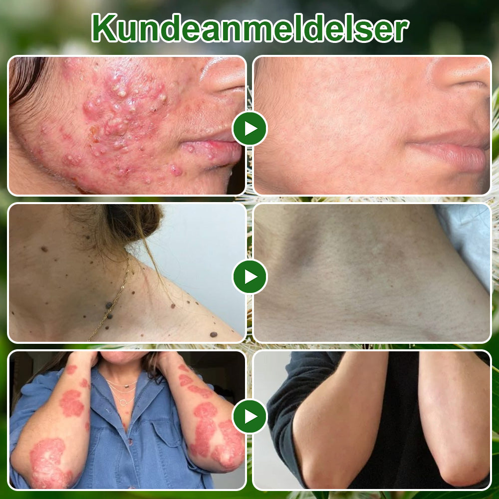 ✅Celsiora® Hudbehandlingscreme med tea tree-olie : Fjerner hudpletter, reparerer beskadiget hud, oplyser huden & anti-aging pleje ❤️‍🔥