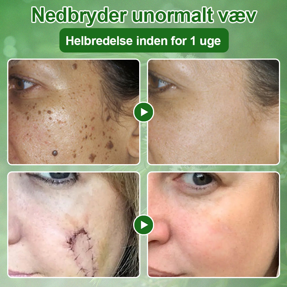 ✅Celsiora® Hudbehandlingscreme med tea tree-olie : Fjerner hudpletter, reparerer beskadiget hud, oplyser huden & anti-aging pleje ❤️‍🔥
