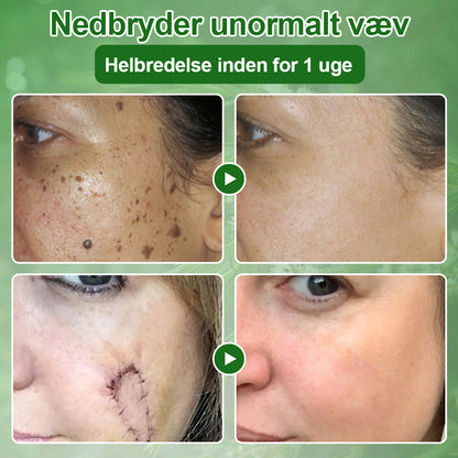 ✅Celsiora® Hudbehandlingscreme med tea tree-olie : Fjerner hudpletter, reparerer beskadiget hud, oplyser huden & anti-aging pleje ❤️‍🔥