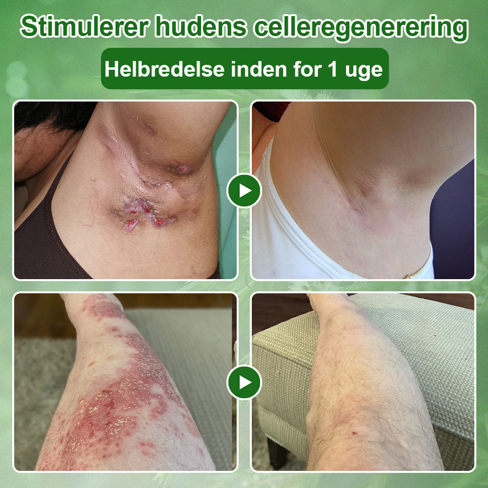 ✅Celsiora® Hudbehandlingscreme med tea tree-olie : Fjerner hudpletter, reparerer beskadiget hud, oplyser huden & anti-aging pleje ❤️‍🔥